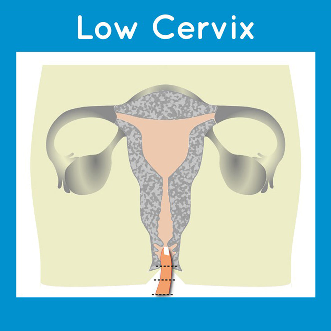 Low Cervix Menstrual Cup- L